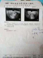 Uterinefibroidsdisappear1.jpg Uterinefibroidsdisappear1.jpg