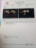 Uterinefibroidsdisappear3.jpg Uterinefibroidsdisappear3.jpg