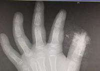 Necroticfingerisreturnedmiraclecontinuestogrowwell1.jpg Necroticfingerisreturnedmiraclecontinuestogrowwell1.jpg