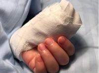 Necroticfingerisreturnedmiraclecontinuestogrowwell2.jpg Necroticfingerisreturnedmiraclecontinuestogrowwell2.jpg