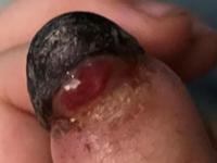 Necroticfingerisreturnedmiraclecontinuestogrowwell5.jpg Necroticfingerisreturnedmiraclecontinuestogrowwell5.jpg