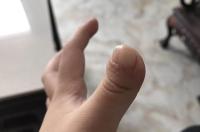 Necroticfingerisreturnedmiraclecontinuestogrowwell6.jpg Necroticfingerisreturnedmiraclecontinuestogrowwell6.jpg