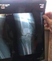 Fracturebloodclotsdisappearedmiraculously1.jpg Fracturebloodclotsdisappearedmiraculously1.jpg