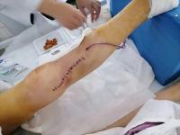 Fracturebloodclotsdisappearedmiraculously2.jpg Fracturebloodclotsdisappearedmiraculously2.jpg