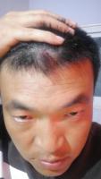 Fracturebloodclotsdisappearedmiraculously3.jpg Fracturebloodclotsdisappearedmiraculously3.jpg