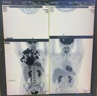 cancercellscontinuetoclear2.jpg cancercellscontinuetoclear2.jpg